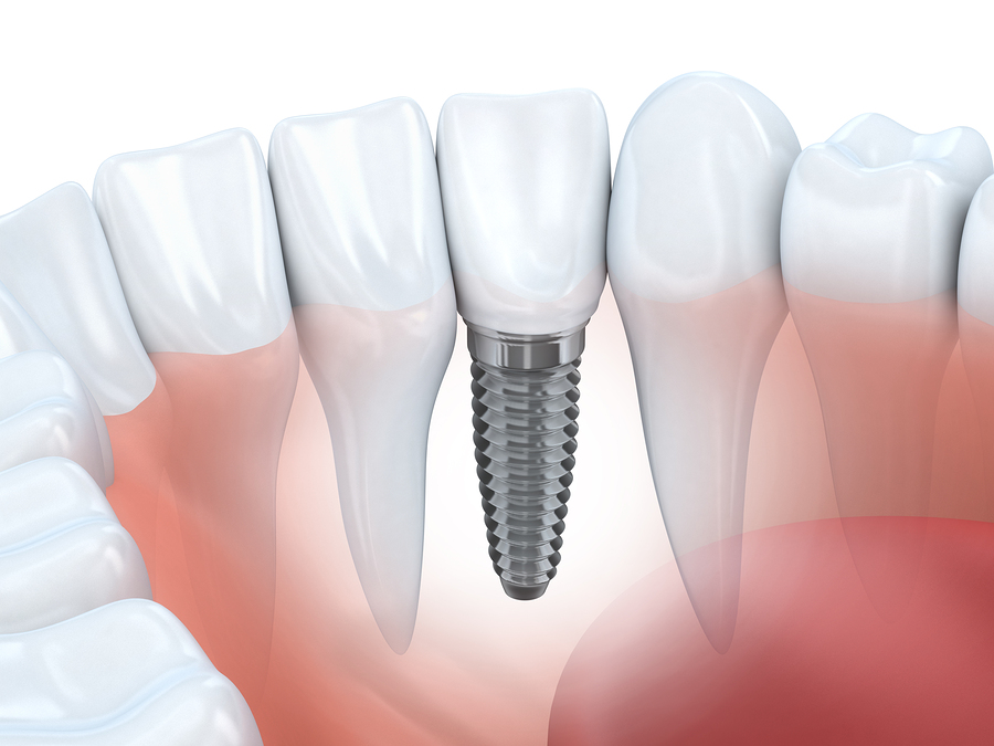 illustration of gums and natural teeth next to tooth with dental implants Dayton, OH